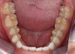 occlusal_lower