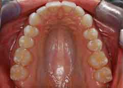 occlusal_upper