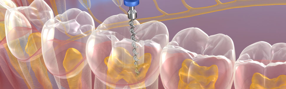 Endodontic root canal treatment process. Medically accurate tooth 3D illustration.