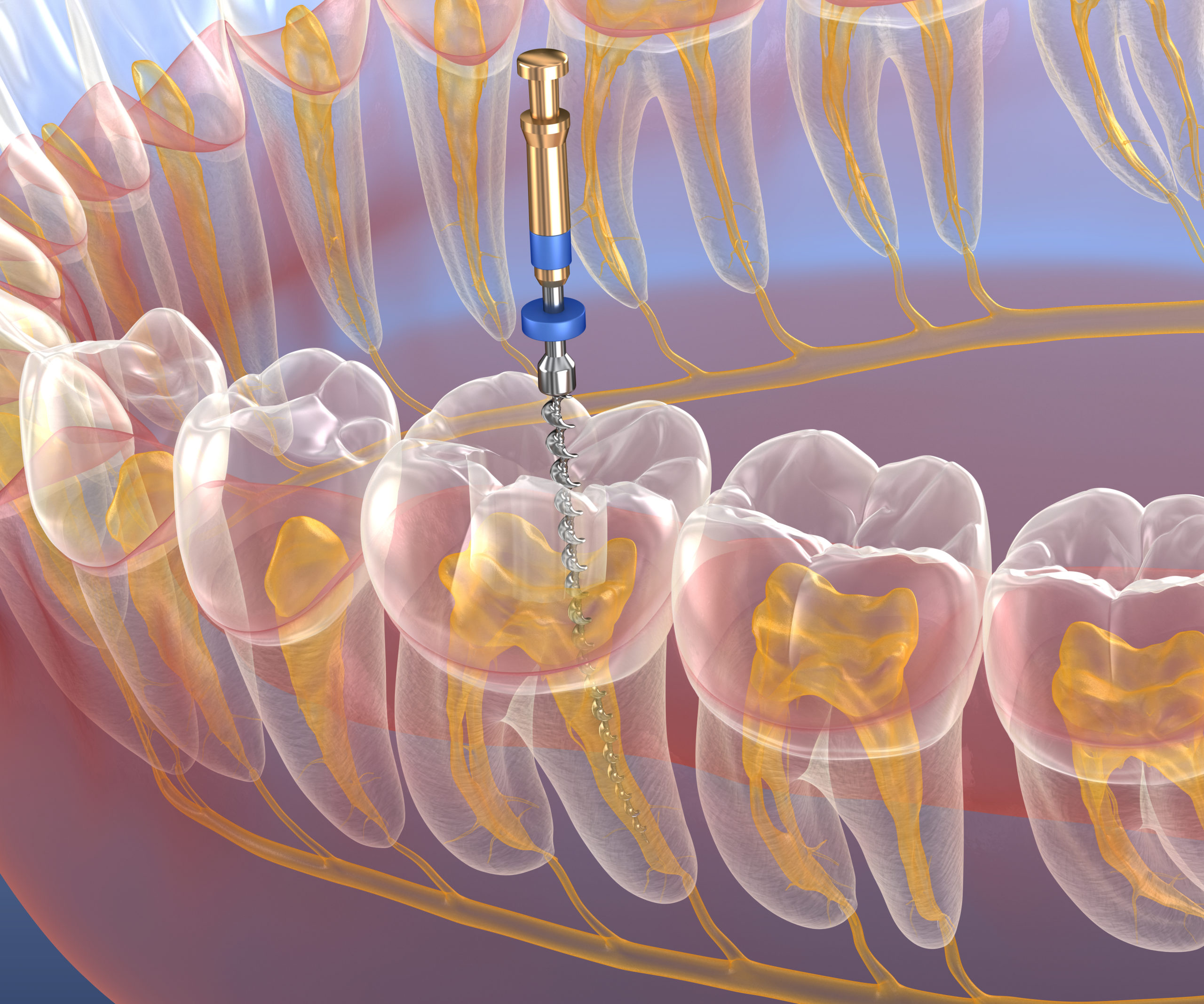 Endodontic root canal treatment process. Medically accurate tooth 3D  illustration. - LVI Global